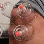 How many sessions are there in Hijama Cupping